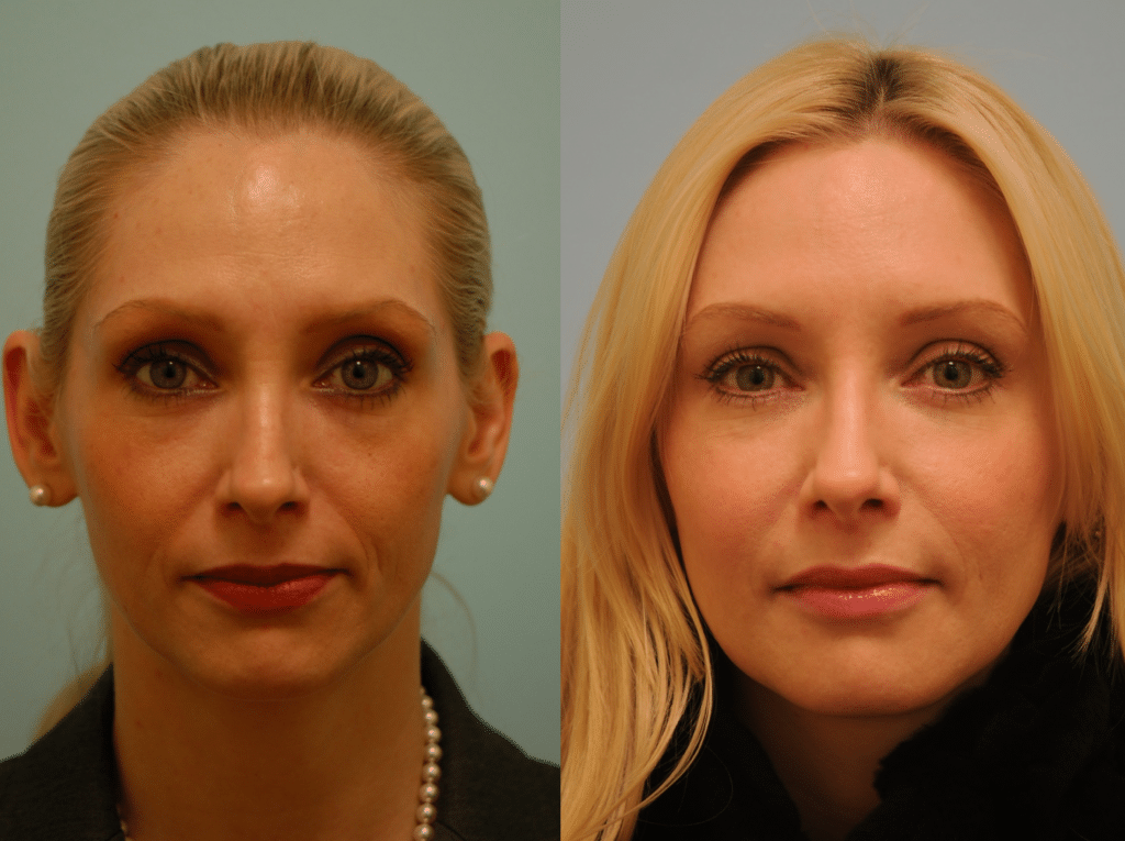 bellafill-restylane-dallas Facial Fillers in Dallas