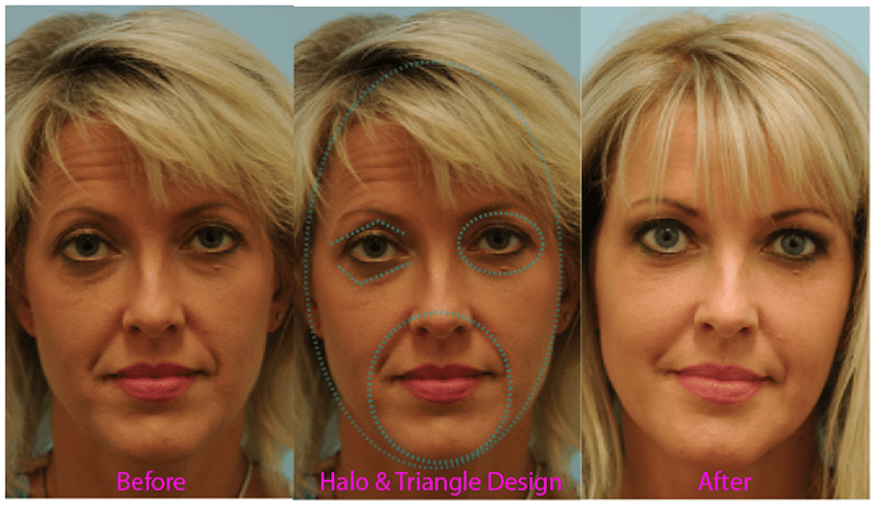 Before & After Fillers