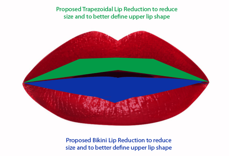 Lip Reduction