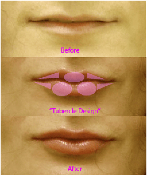 injectable filler comparison