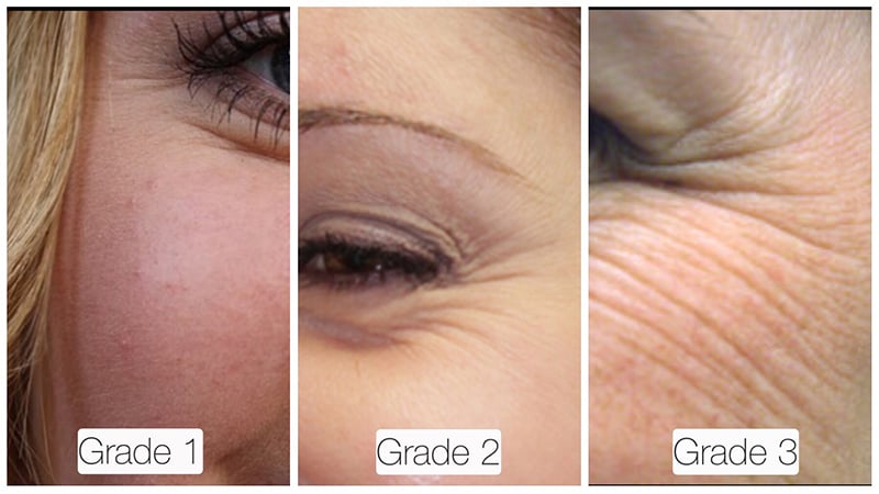 Crow's Feet Wrinkle Grades Botox Treatment