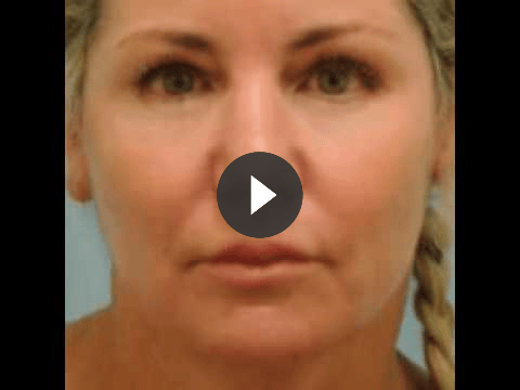Laser Skin video