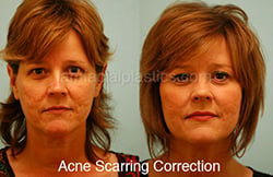 Acne Scarring Before and After