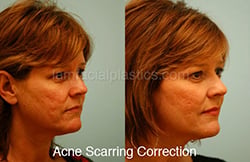Acne Scarring Before and After