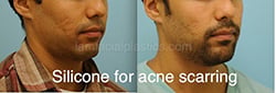 Acne Scarring Before and After