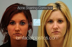 Acne Scarring Before and After