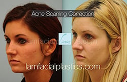 Acne Scarring Before and After