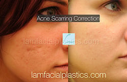 Acne Scarring Before and After