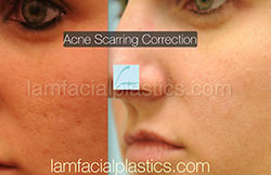 Acne Scarring Before and After