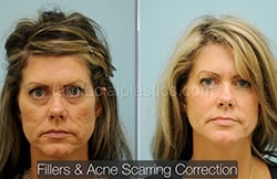 Acne Scarring Before and After
