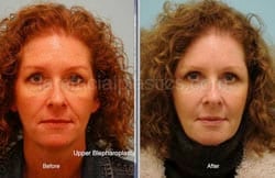 Upper and Lower Eyelid Surgery Before & After
