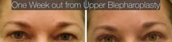 Upper and Lower Eyelid Surgery Before & After