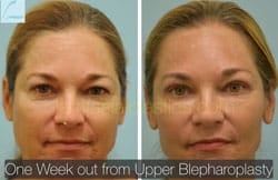 Upper and Lower Eyelid Surgery Before & After