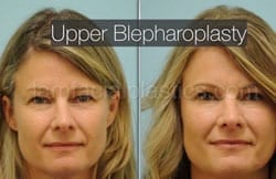 Upper and Lower Eyelid Surgery Before & After