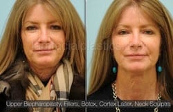 Upper and Lower Eyelid Surgery Before & After