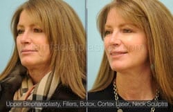 Upper and Lower Eyelid Surgery Before & After