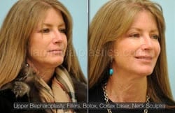 Upper and Lower Eyelid Surgery Before & After