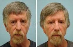 Upper and Lower Eyelid Surgery Before & After