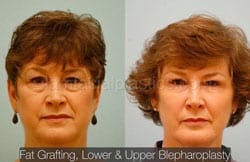 Upper and Lower Eyelid Surgery Before & After
