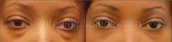 Upper and Lower Eyelid Surgery Before & After