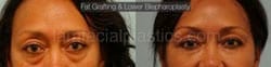 Upper and Lower Eyelid Surgery Before & After