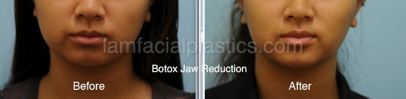Botox Results Dallas