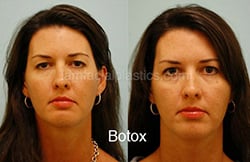 Botox Results Dallas