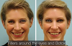 Botox Results Dallas