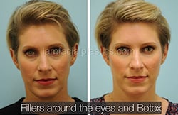 Botox Results Dallas