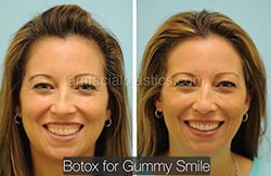 Botox Results Dallas