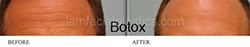 Botox Results Dallas