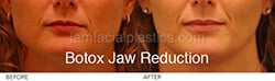 Botox Results Dallas