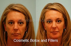 Botox Results Dallas