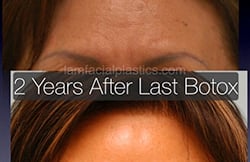 Botox Results Dallas