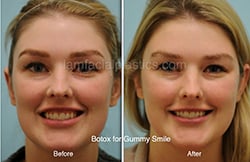 Botox Results Dallas