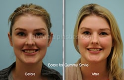Botox Results Dallas