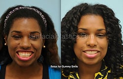 Botox Results Dallas