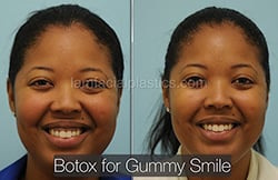 Botox Results Dallas