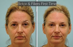 Botox Results Dallas