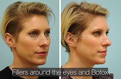 Botox Results Dallas