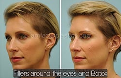 Botox Results Dallas