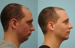 Chin Augmentation Before & After
