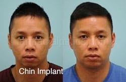 Chin Augmentation Before & After