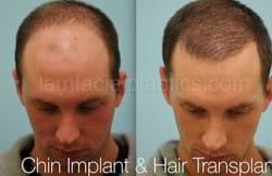 Chin Augmentation Before & After