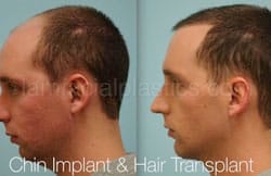 Chin Augmentation Before & After