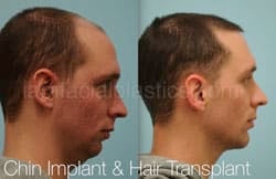 Chin Augmentation Before & After