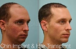 Chin Augmentation Before & After