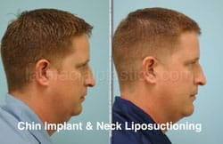 Chin Augmentation Before & After