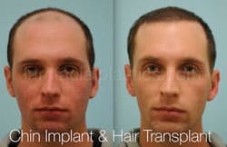 Chin Augmentation Before & After
