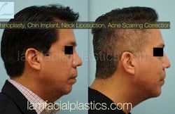 Chin Augmentation Before & After